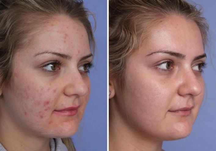 Before &After